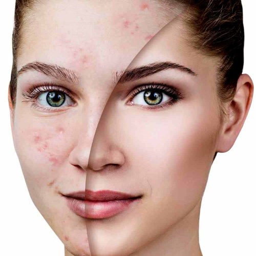 acne-laser-treatment